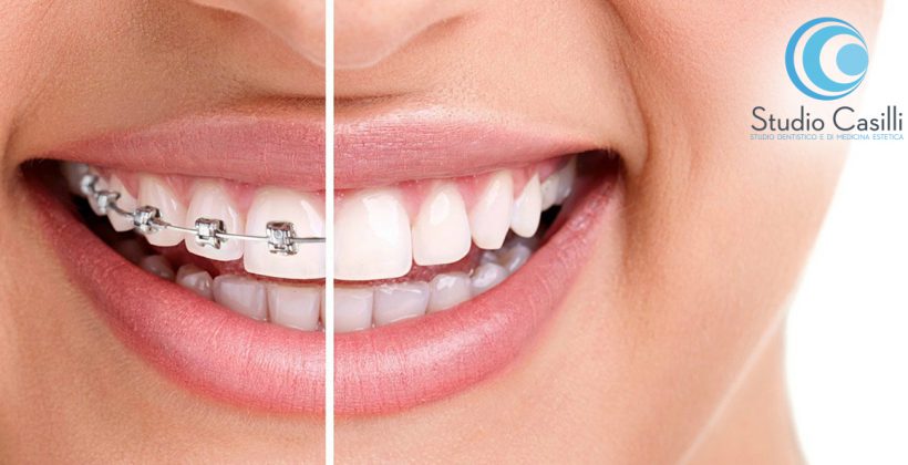apparecchio-denti-messina
