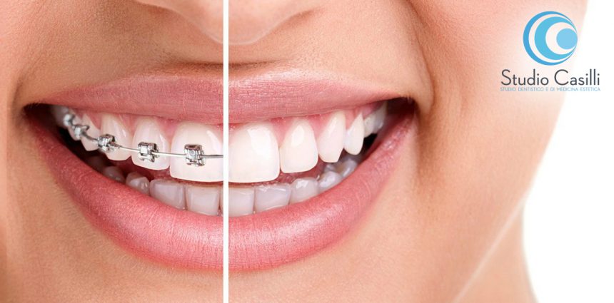 Ortodonzia – Apparecchi per denti