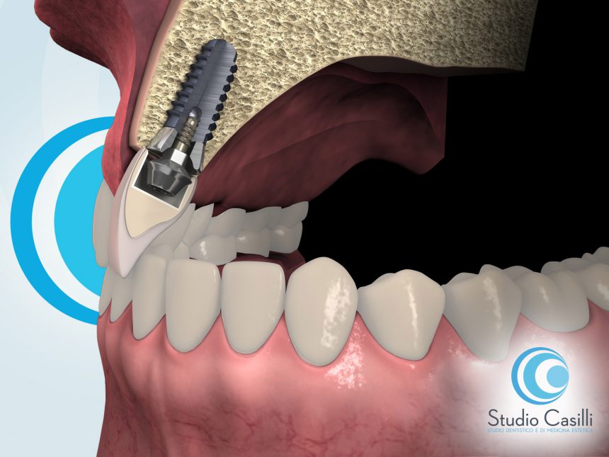 Implantologia – Impianti Dentali